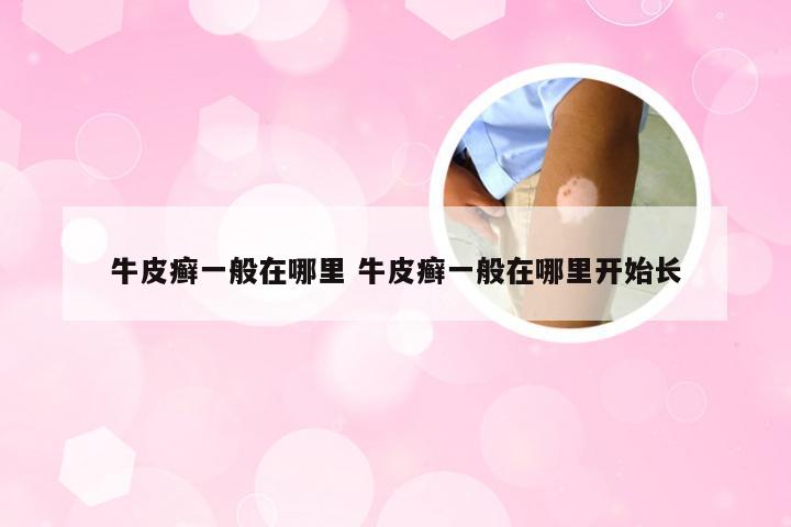 牛皮癣一般在哪里 牛皮癣一般在哪里开始长