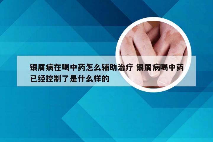 银屑病在喝中药怎么辅助治疗 银屑病喝中药已经控制了是什么样的