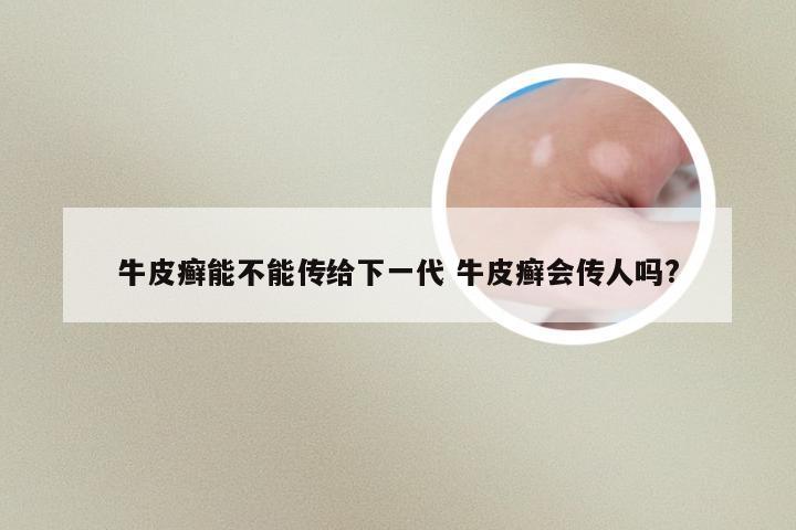 牛皮癣能不能传给下一代 牛皮癣会传人吗?