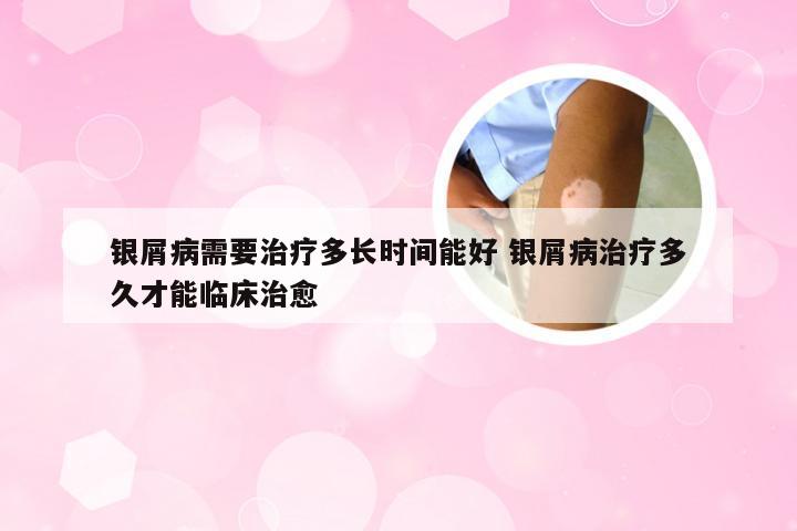 银屑病需要治疗多长时间能好 银屑病治疗多久才能临床治愈
