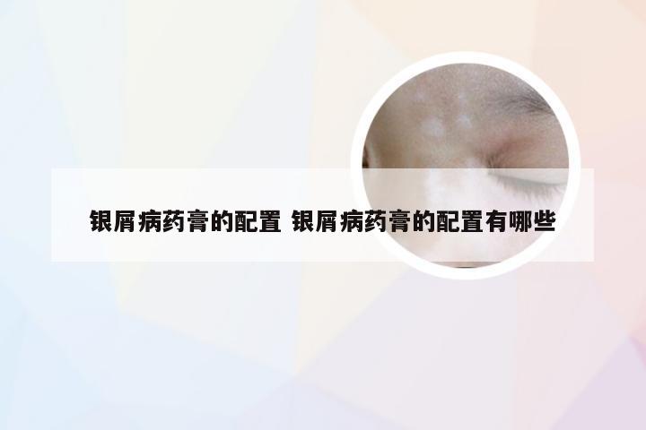 银屑病药膏的配置 银屑病药膏的配置有哪些