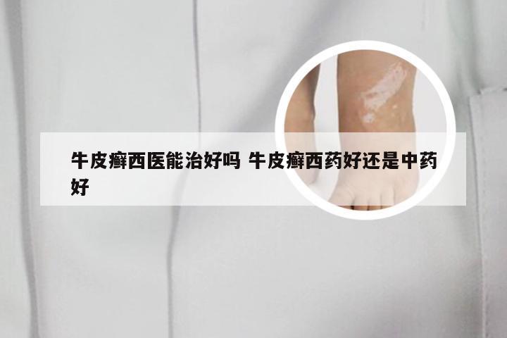 牛皮癣西医能治好吗 牛皮癣西药好还是中药好