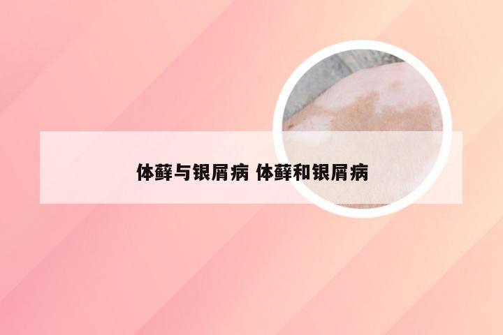 体藓与银屑病 体藓和银屑病