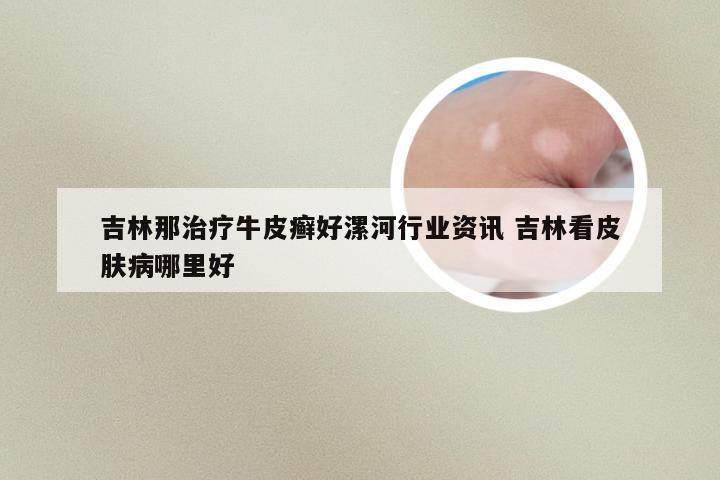 吉林那治疗牛皮癣好漯河行业资讯 吉林看皮肤病哪里好