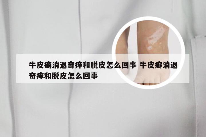 牛皮癣消退奇痒和脱皮怎么回事 牛皮癣消退奇痒和脱皮怎么回事