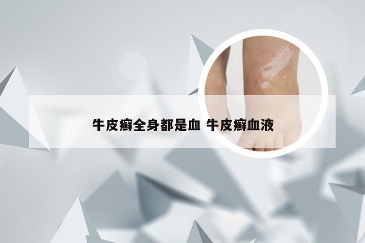 牛皮癣全身都是血 牛皮癣血液