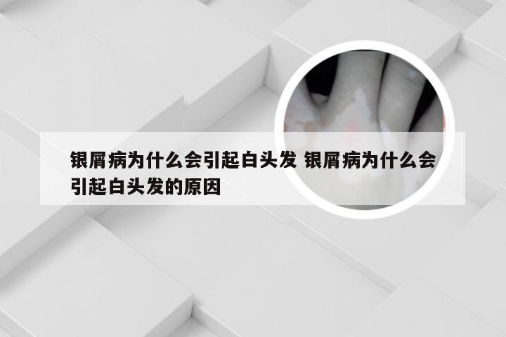 银屑病为什么会引起白头发 银屑病为什么会引起白头发的原因