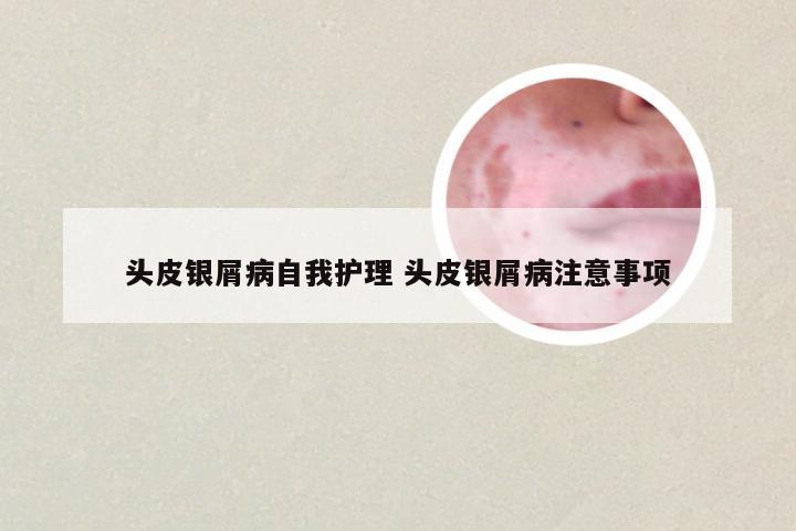 头皮银屑病自我护理 头皮银屑病注意事项