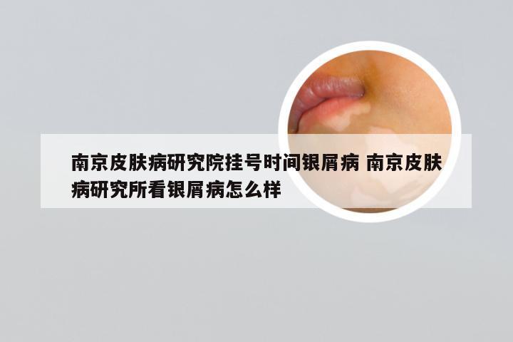 南京皮肤病研究院挂号时间银屑病 南京皮肤病研究所看银屑病怎么样