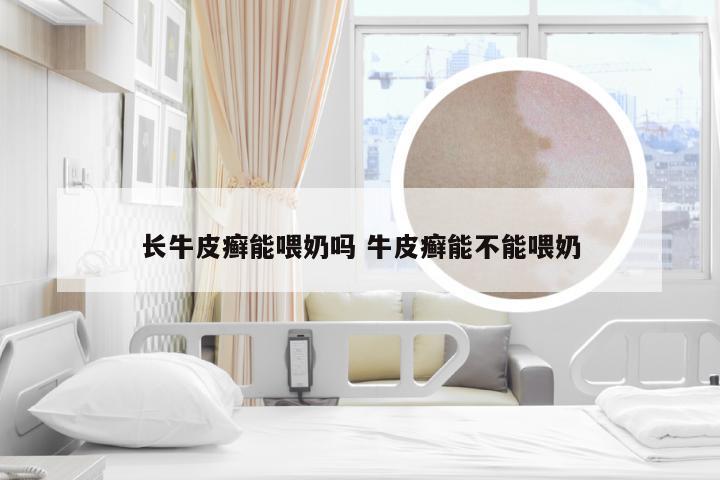 长牛皮癣能喂奶吗 牛皮癣能不能喂奶