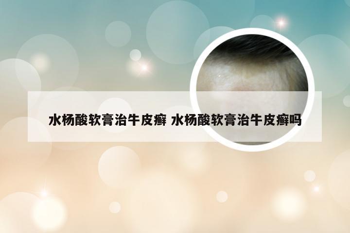 水杨酸软膏治牛皮癣 水杨酸软膏治牛皮癣吗