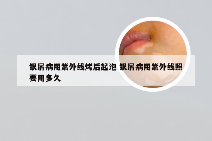 银屑病用紫外线烤后起泡 银屑病用紫外线照要用多久