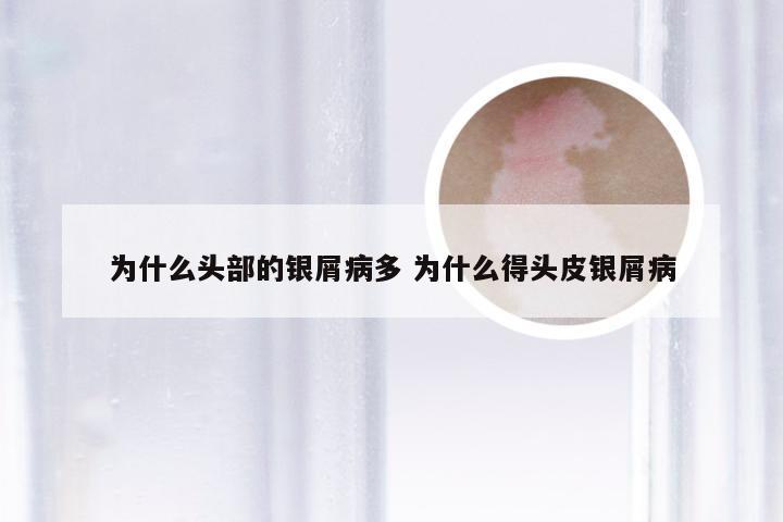 为什么头部的银屑病多 为什么得头皮银屑病