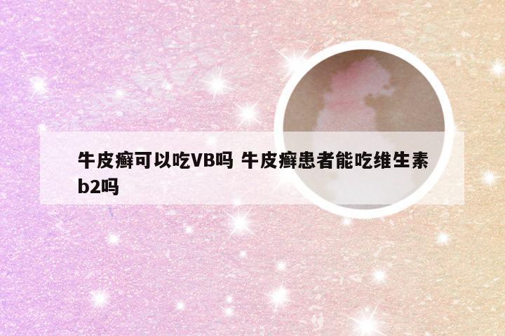 牛皮癣可以吃VB吗 牛皮癣患者能吃维生素b2吗