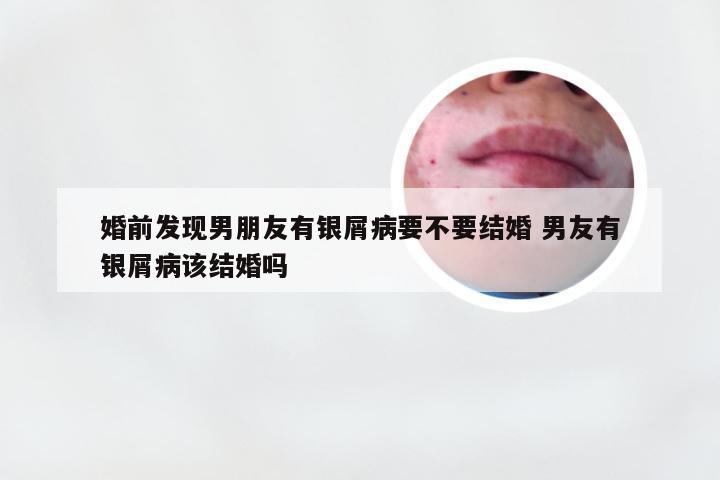 婚前发现男朋友有银屑病要不要结婚 男友有银屑病该结婚吗