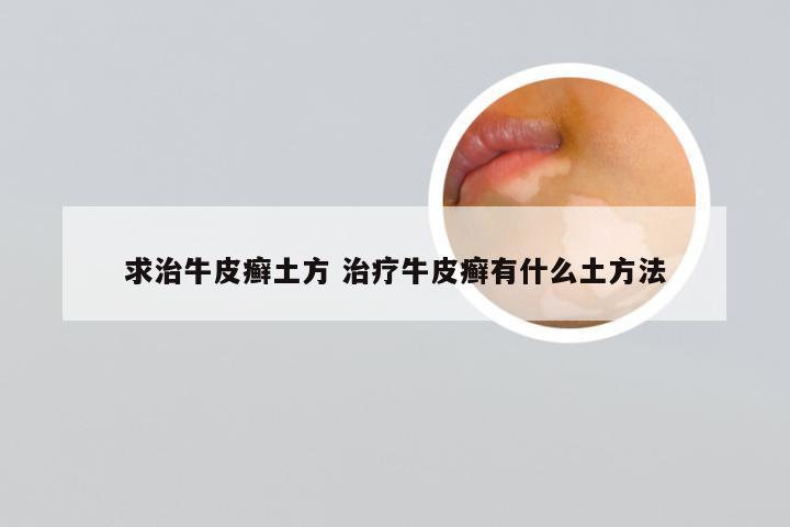 求治牛皮癣土方 治疗牛皮癣有什么土方法