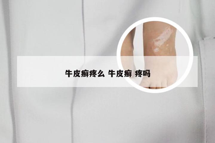 牛皮癣疼么 牛皮癣 疼吗