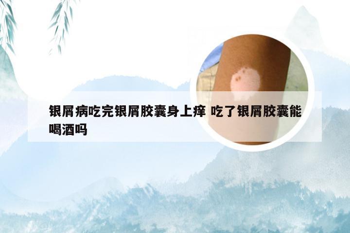 银屑病吃完银屑胶囊身上痒 吃了银屑胶囊能喝酒吗