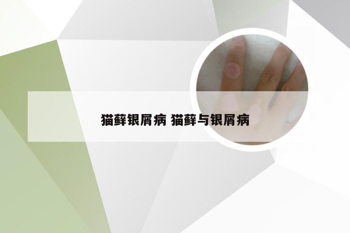 猫藓银屑病 猫藓与银屑病