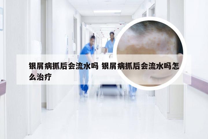 银屑病抓后会流水吗 银屑病抓后会流水吗怎么治疗
