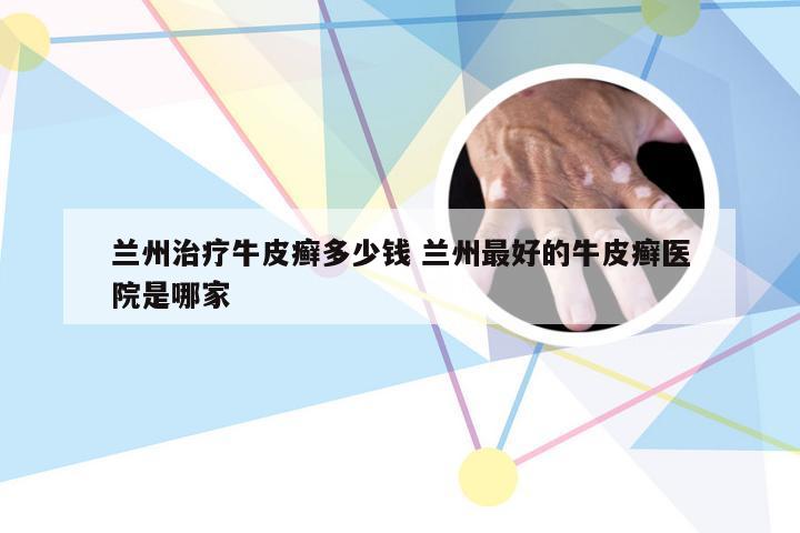 兰州治疗牛皮癣多少钱 兰州最好的牛皮癣医院是哪家