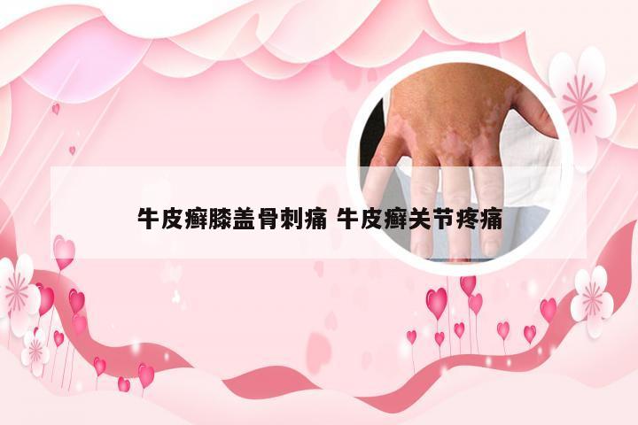 牛皮癣膝盖骨刺痛 牛皮癣关节疼痛