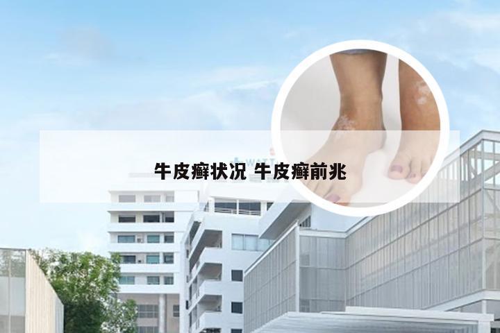 牛皮癣状况 牛皮癣前兆