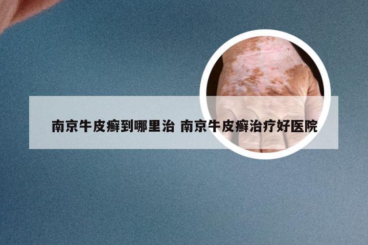 南京牛皮癣到哪里治 南京牛皮癣治疗好医院