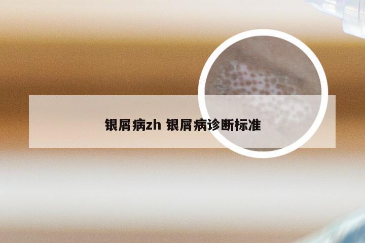 银屑病zh 银屑病诊断标准