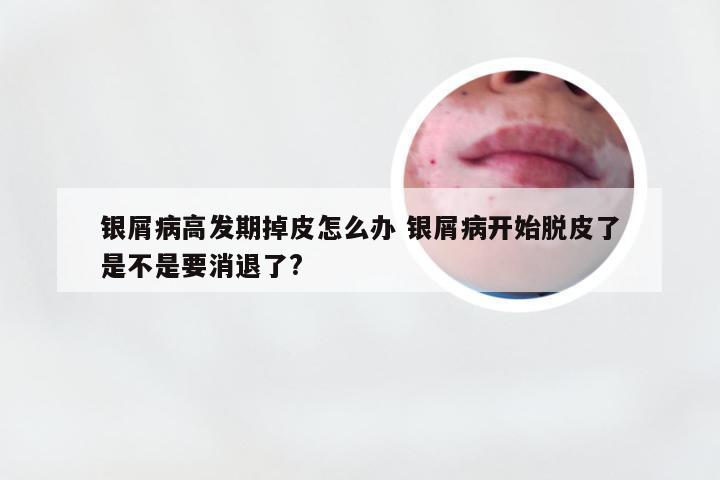 银屑病高发期掉皮怎么办 银屑病开始脱皮了是不是要消退了?