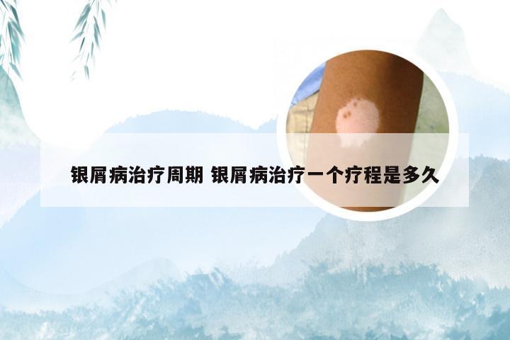 银屑病治疗周期 银屑病治疗一个疗程是多久