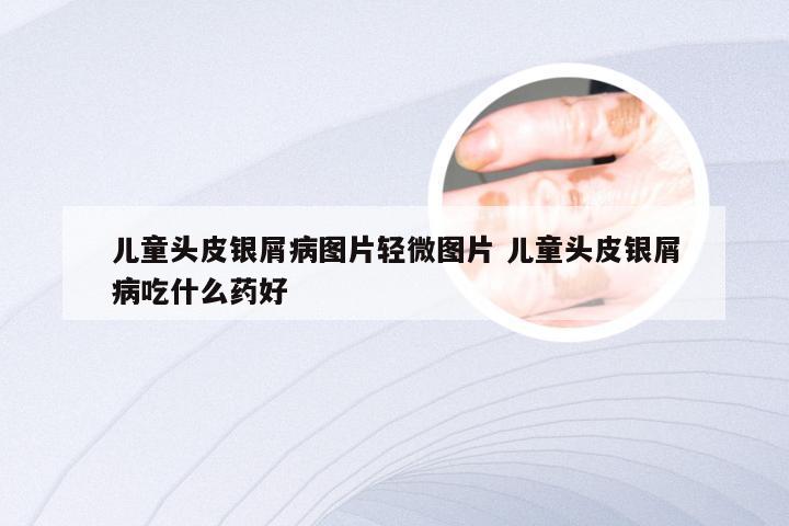儿童头皮银屑病图片轻微图片 儿童头皮银屑病吃什么药好