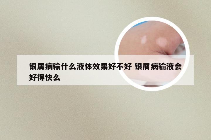 银屑病输什么液体效果好不好 银屑病输液会好得快么