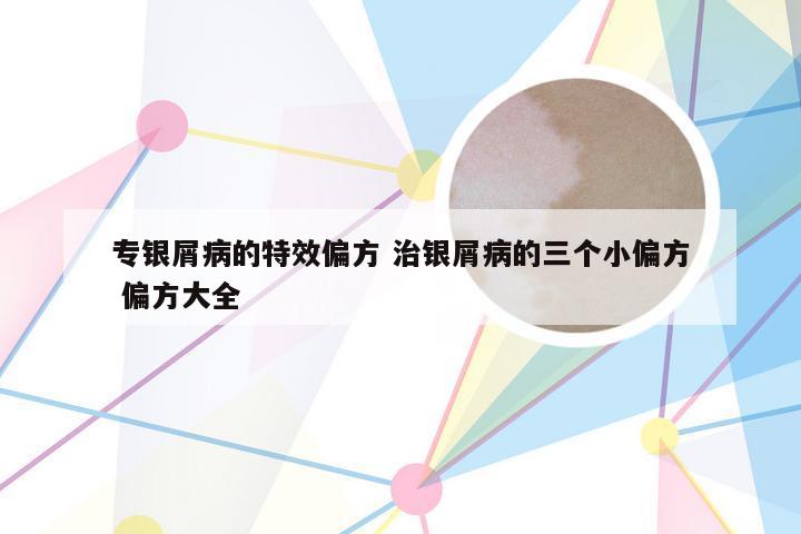 专银屑病的特效偏方 治银屑病的三个小偏方 偏方大全