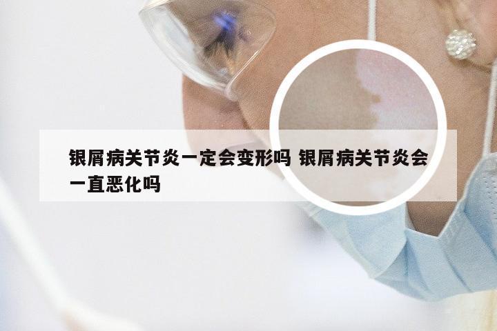 银屑病关节炎一定会变形吗 银屑病关节炎会一直恶化吗