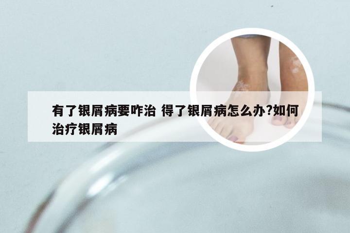 有了银屑病要咋治 得了银屑病怎么办?如何治疗银屑病