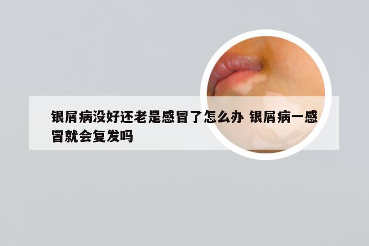 银屑病没好还老是感冒了怎么办 银屑病一感冒就会复发吗