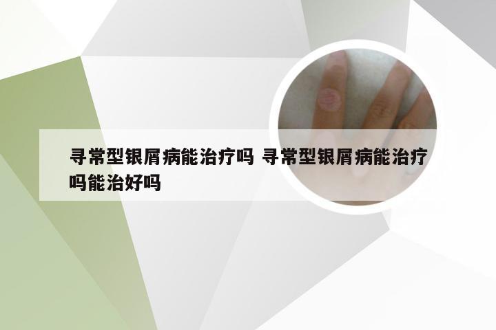 寻常型银屑病能治疗吗 寻常型银屑病能治疗吗能治好吗
