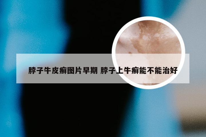 脖子牛皮癣图片早期 脖子上牛癣能不能治好