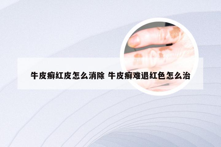 牛皮癣红皮怎么消除 牛皮癣难退红色怎么治