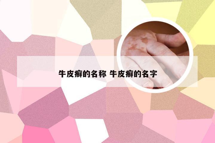 牛皮癣的名称 牛皮癣的名字
