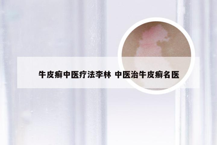 牛皮癣中医疗法李林 中医治牛皮癣名医