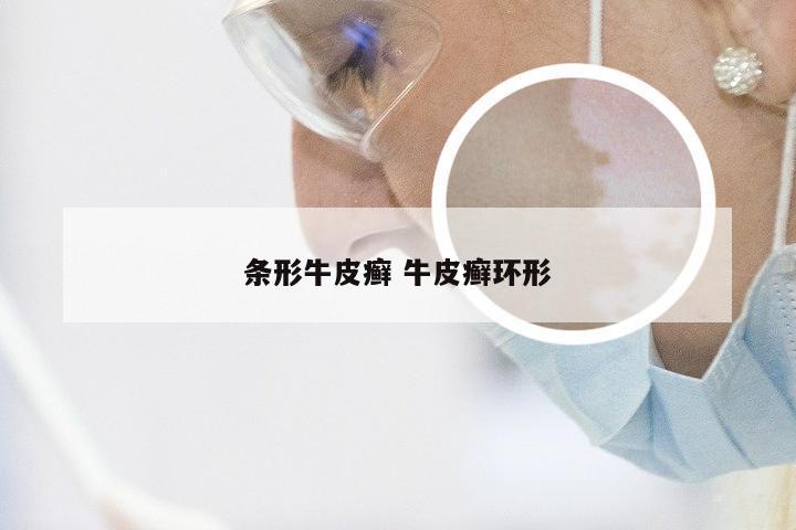条形牛皮癣 牛皮癣环形