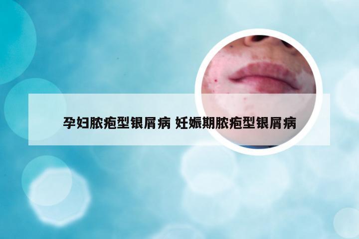 孕妇脓疱型银屑病 妊娠期脓疱型银屑病