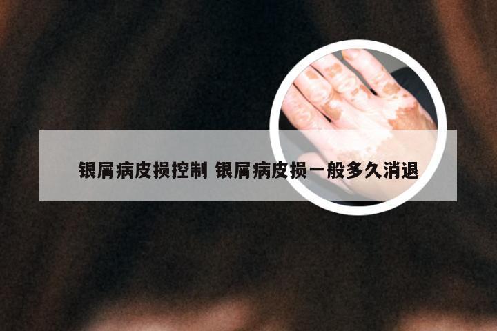 银屑病皮损控制 银屑病皮损一般多久消退