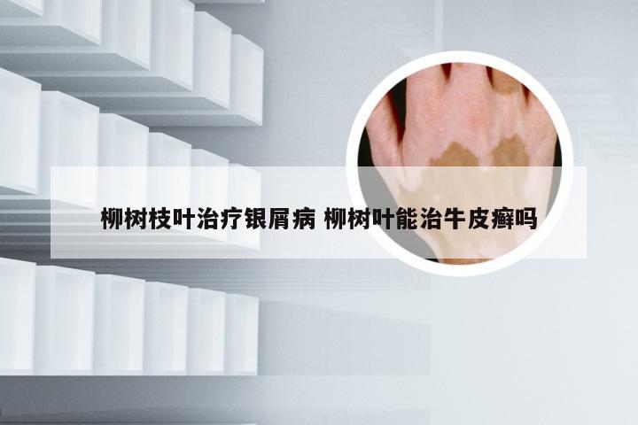 柳树枝叶治疗银屑病 柳树叶能治牛皮癣吗