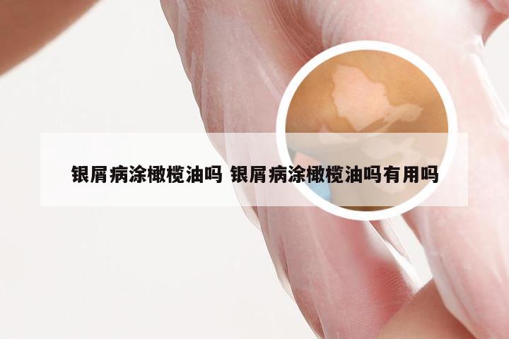 银屑病涂橄榄油吗 银屑病涂橄榄油吗有用吗