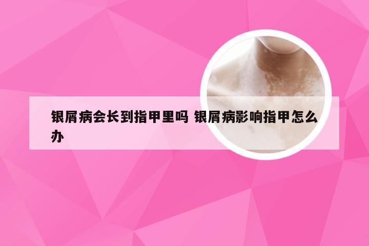 银屑病会长到指甲里吗 银屑病影响指甲怎么办
