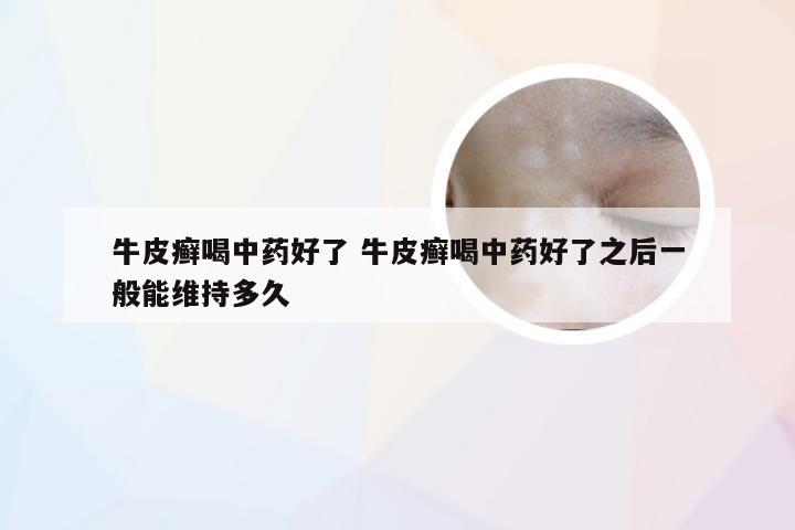 牛皮癣喝中药好了 牛皮癣喝中药好了之后一般能维持多久
