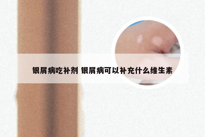 银屑病吃补剂 银屑病可以补充什么维生素